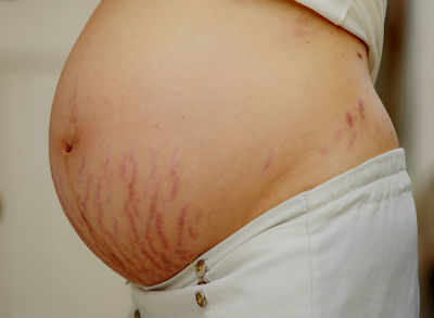 The difference between red and white stretch marks - Times of India