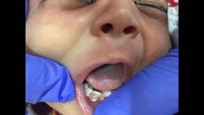 Gujarat: Doctors extract seven teeth from one-month-old's mouth