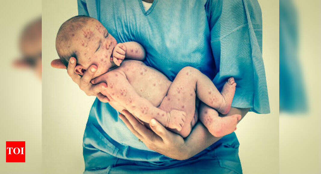 Measles cases in India dropped by 43 in a year WHO Times of India