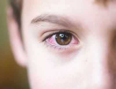 Teen's sore eyes refuse to heal, docs find it's drug-resistant TB