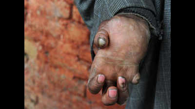 Leprosy far from eradication in Nagpur district