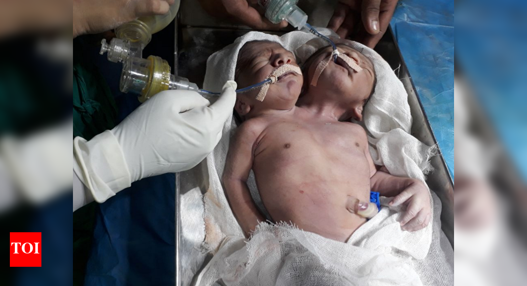 Birth of rare dicephalic parapagus twins leaves Beed doctors in shock