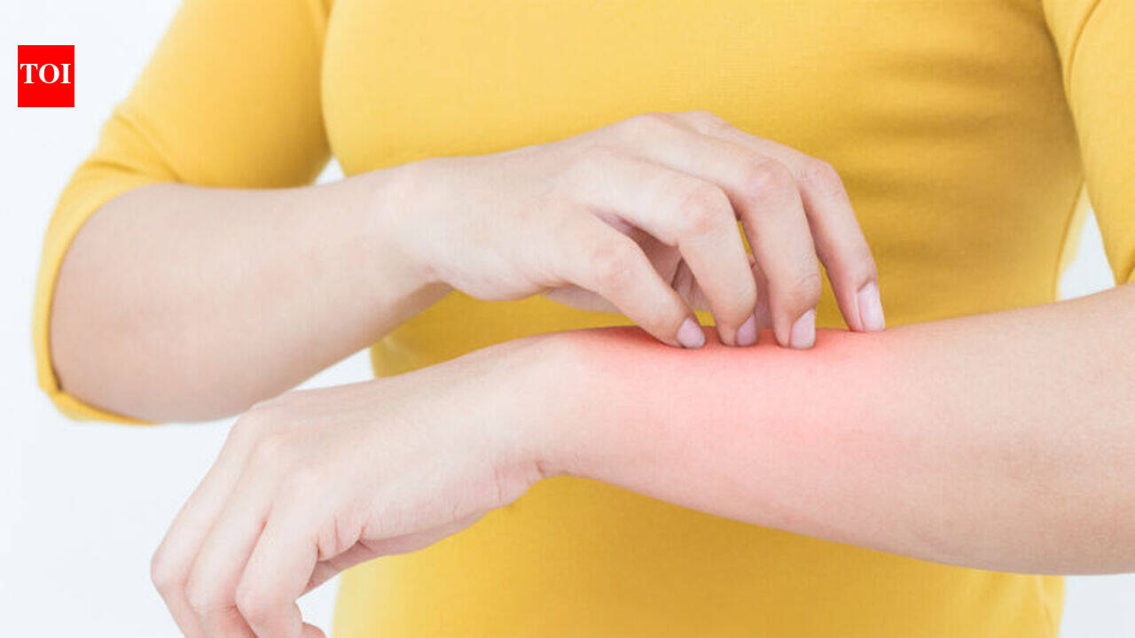 The right way to treat THESE insect bites!