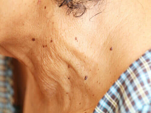 Birthmark on forehead astrology