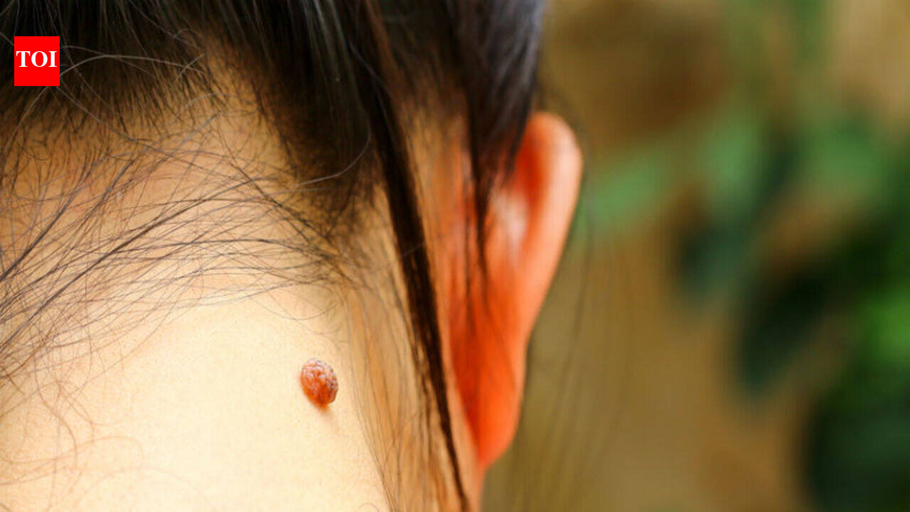 What having birthmark on these parts of your body really means | The ...