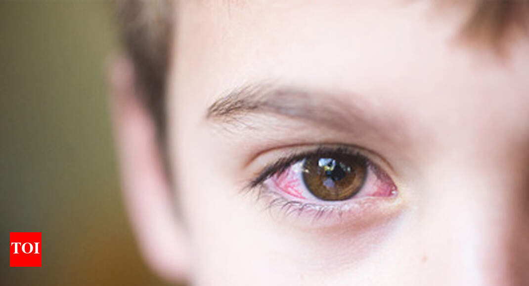 Swollen, bleeding eye infection puts Chennai in panic’s scopes