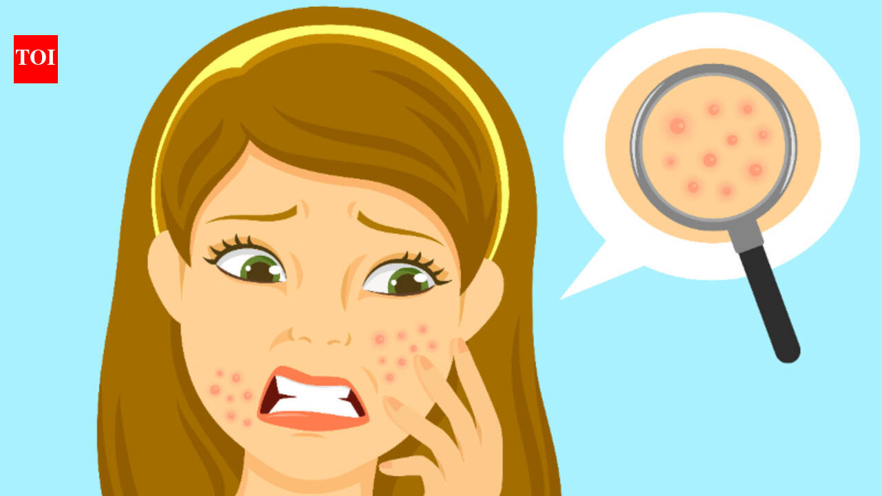 How to get rid of pimples fast