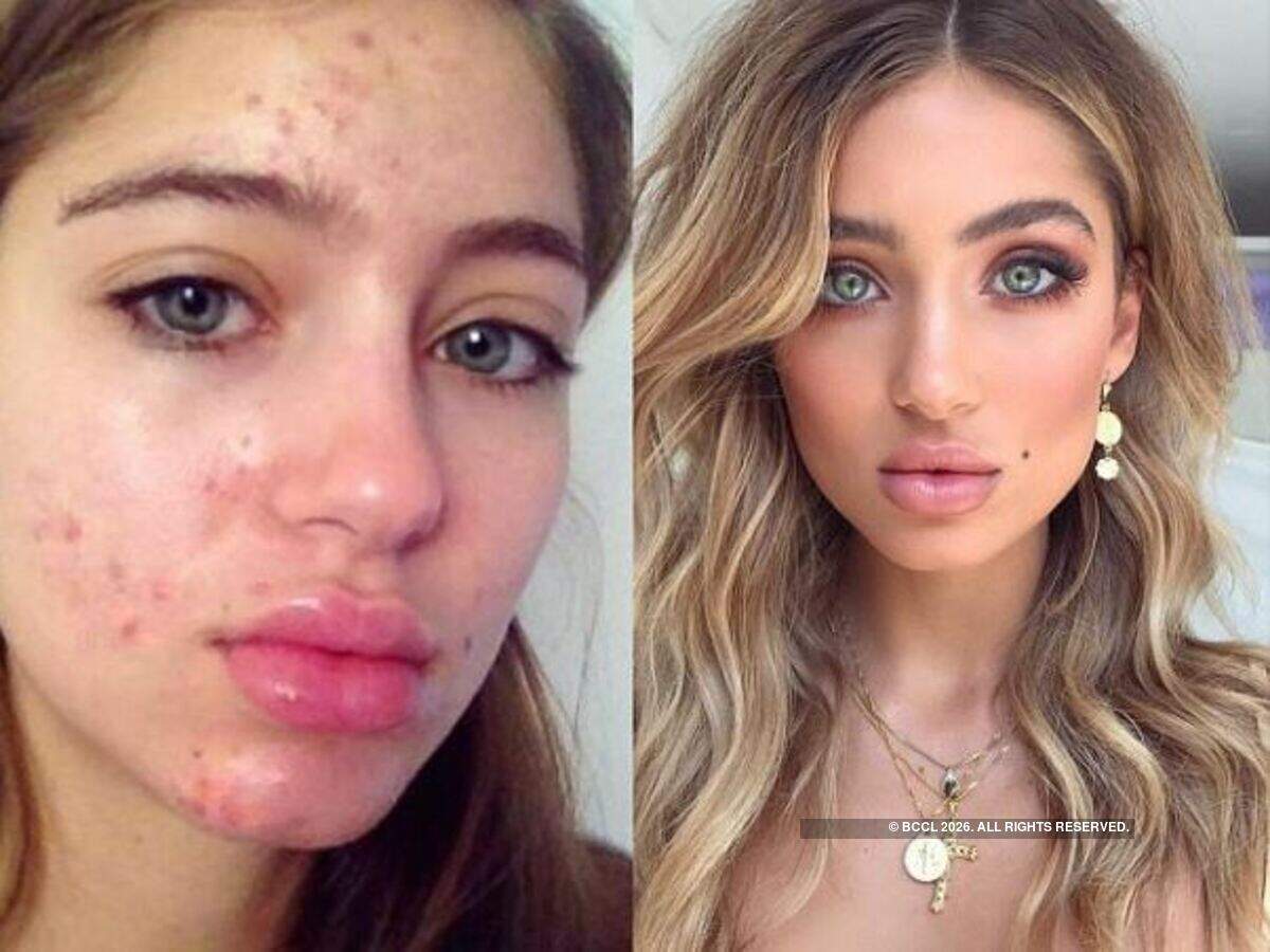 Model Belle Lucia Reveals Incredible Acne Transformation