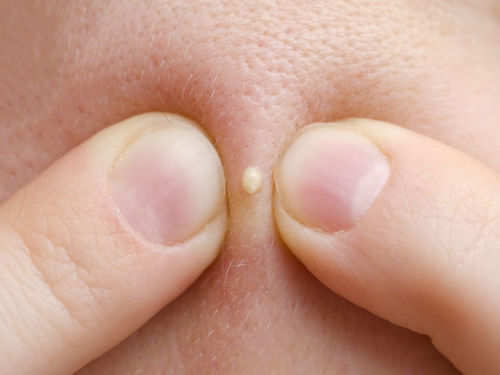 Got acne in pubic area? 5 remedies to treat it! | The Times of India