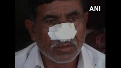Uttar Pradesh: Man bites off brother's nose after denied money for alcohol