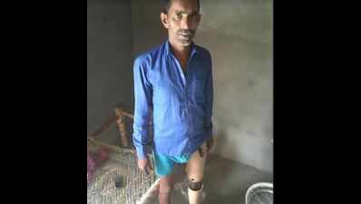 Mathura’s disabled man gets prosthetic leg from Rajasthan