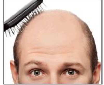 New cure for baldness on the way - Times of India