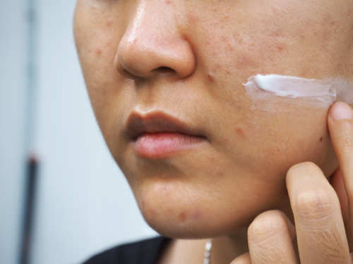 Why you should not apply toothpaste on your pimple | The Times of India