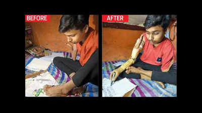 Delhi: Daily-wager's son cites RTE, gets prosthetic arm from govt