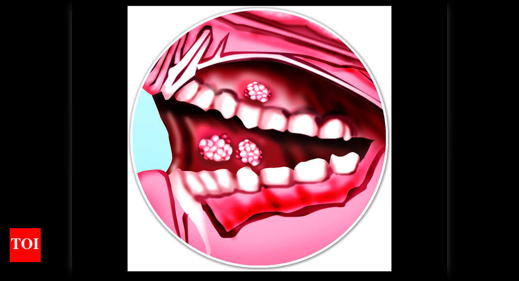 Pictures Of Mouth Cancer
