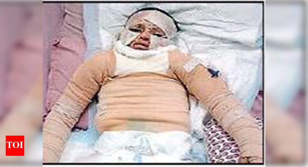 Sixyearold boy survives 60 burns due to electric shocks Bengaluru