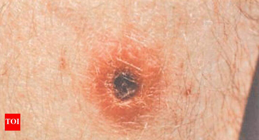 Can Scrub Typhus Cause Death