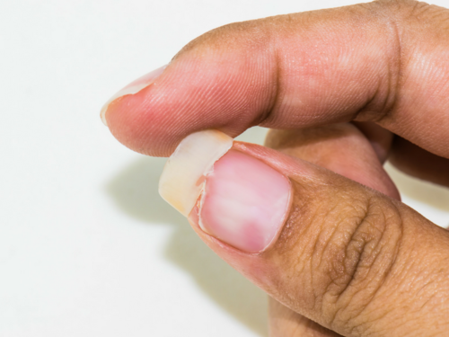 Broken or yellow nails? 7 warning signs your nails are trying to tell you! | The Times of India Broken or yellow nails? 7 warning signs your nails are trying to tell you! | The Times of India