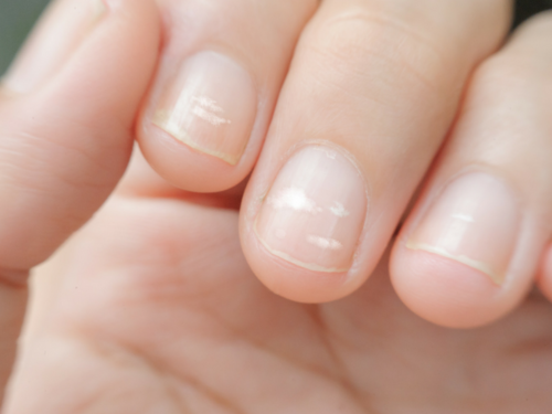 Broken or yellow nails? 7 warning signs your nails are trying to tell you! | The Times of India Broken or yellow nails? 7 warning signs your nails are trying to tell you! | The Times of India