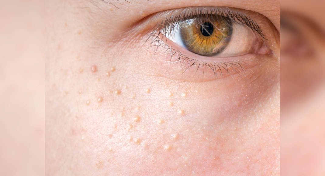 Small White Spots On Face Treatment