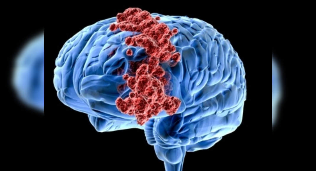 brain-cancer-treatment-brain-cancer-treatment-researchers-claim-that