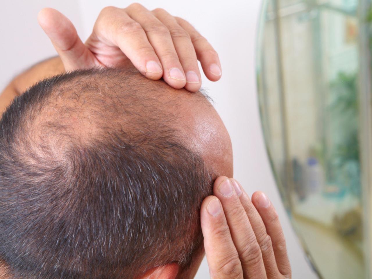 Cure for baldness might be hiding in your hairy moles study