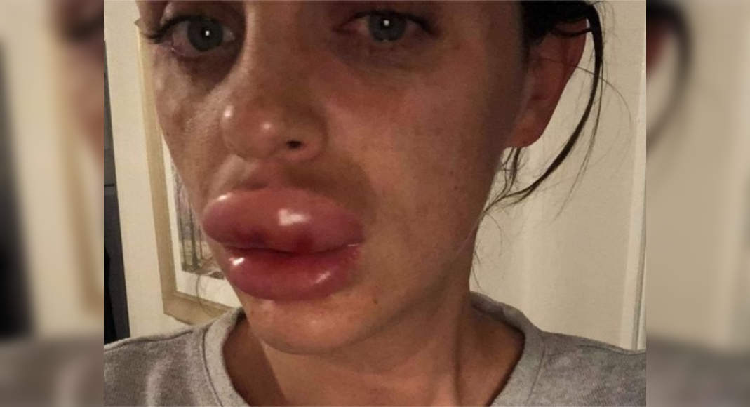 Girl warns people against getting lip filler injections after botox