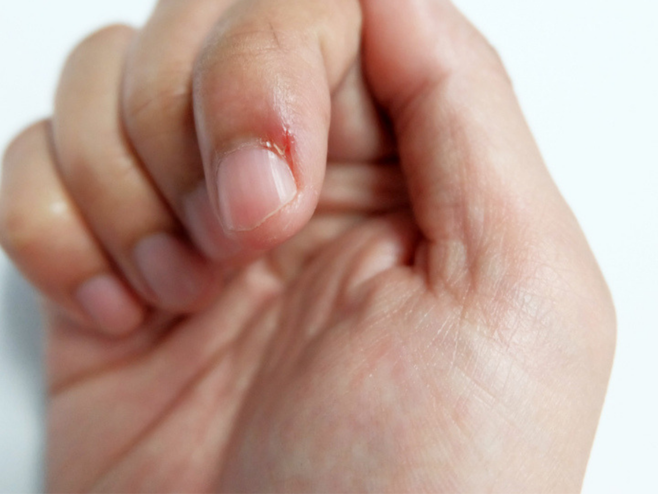 Skin Picking Disorder: A disorder dangerous than nail-biting itself! | What  is Skin Picking, Signs, Cause and How to Stop it | - Times of India
