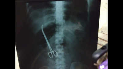 At Hyderabad hospital, doctor leaves scissors in patient's stomach during surgery