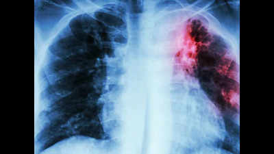 300 tuberculosis patients identified in a span of 4 weeks