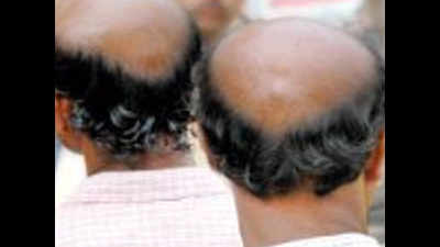 Hair now gone the next Here s the bald truth Indore News