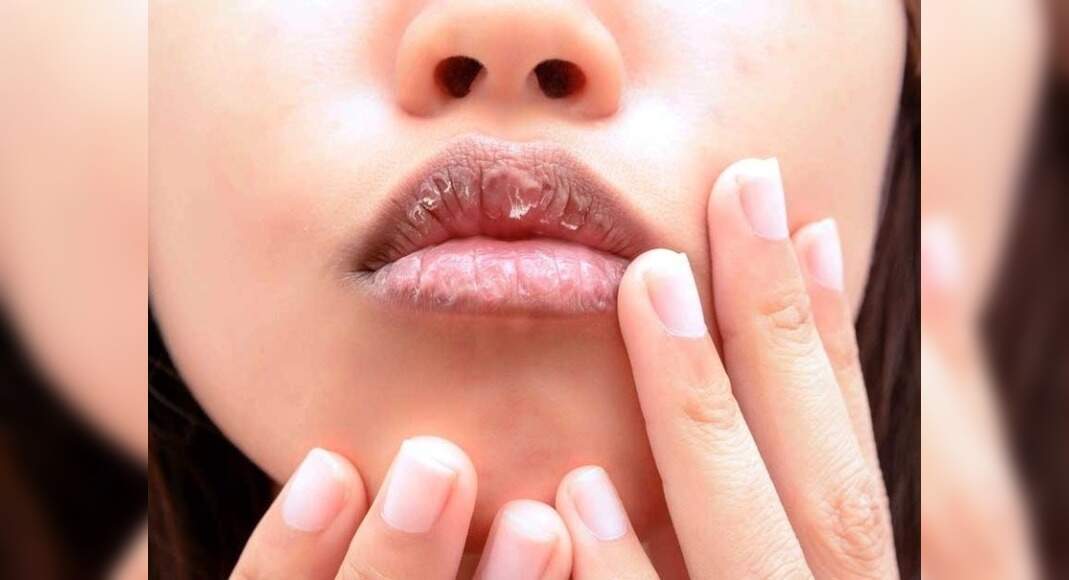 Medicated lip balms to stop peeling & flaking of lips Misskyra