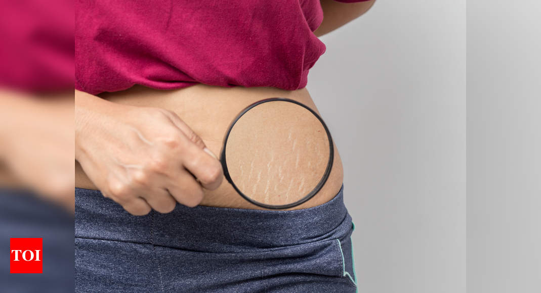 How To Get Rid of Stretch Marks? Top 3 Methods Explained