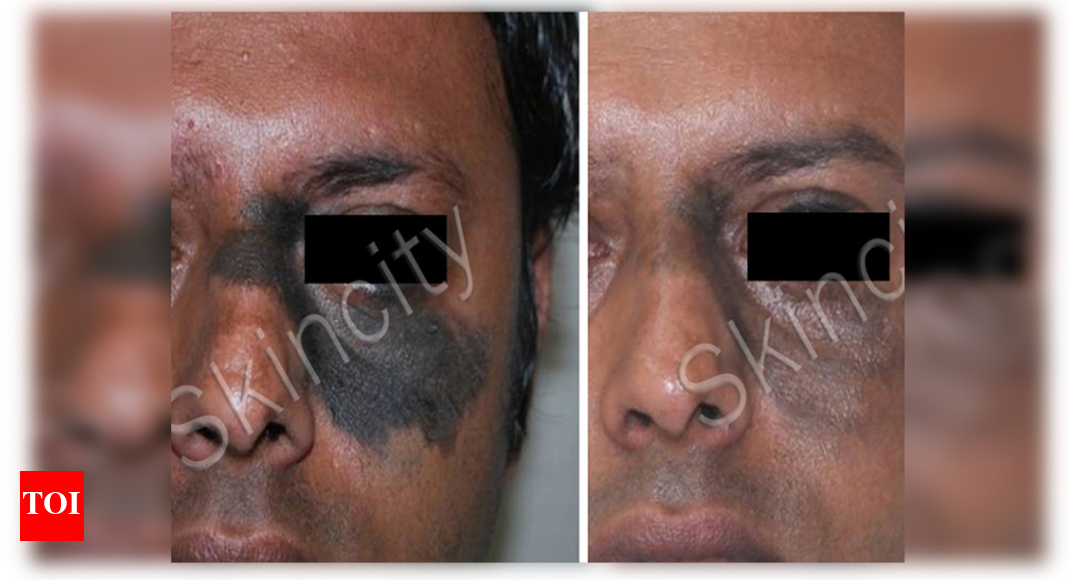 How To Get Rid Of Birthmarks Naturally 3 Get Rid Of It Now - vzq2gsh