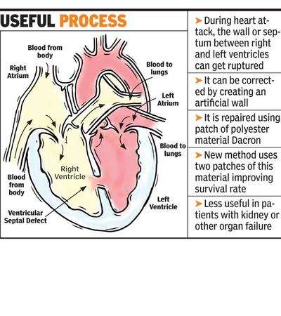 New technique ups survival rate of heart attack patients | Nagpur News ...