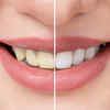 turmeric and baking soda teeth whitening