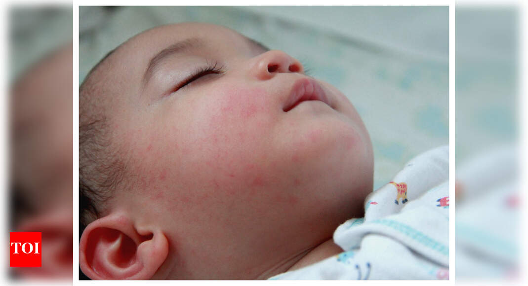 What should you do about the red, dry and itchy skin in newborns