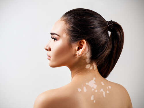 Can having milk and fish together give you white patches on skin? Science has the answer | The Times of India Can having milk and fish together give you white patches on skin? Science has the answer | The Times of India