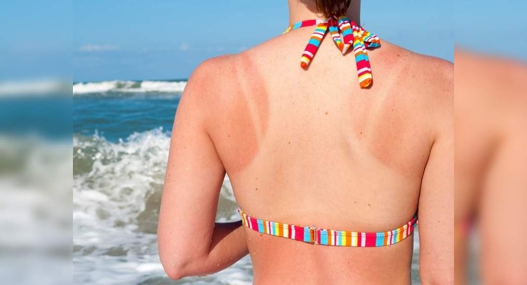 Treating Sunburn All The Ways In Which You Can Effectively Treat Sunburns Misskyra Com