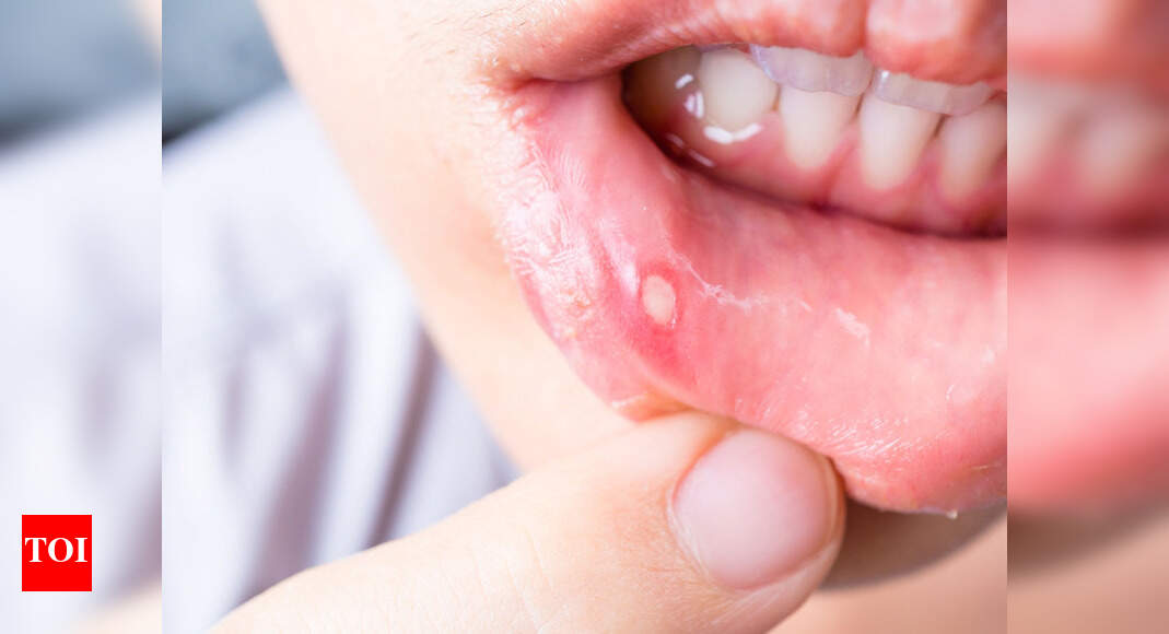 Here's what you can eat to cure mouth ulcers Times of India