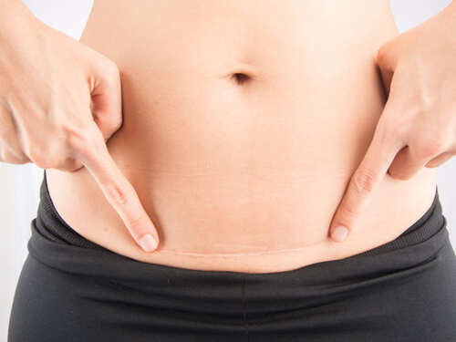 Midwife And Life How To Look After Your C Section Scar To Promote Healing And Reduce Scarring Midwife And Life