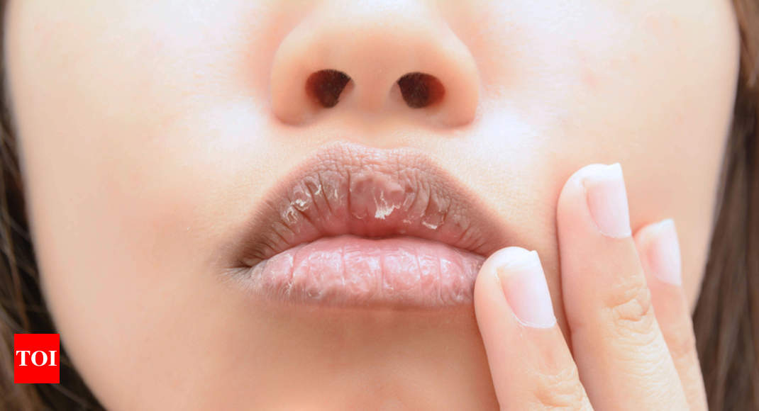 Overtekenen Uitvoerbaar Ongrijpbaar How to treat dry and chapped lips using home remedies - Times of India