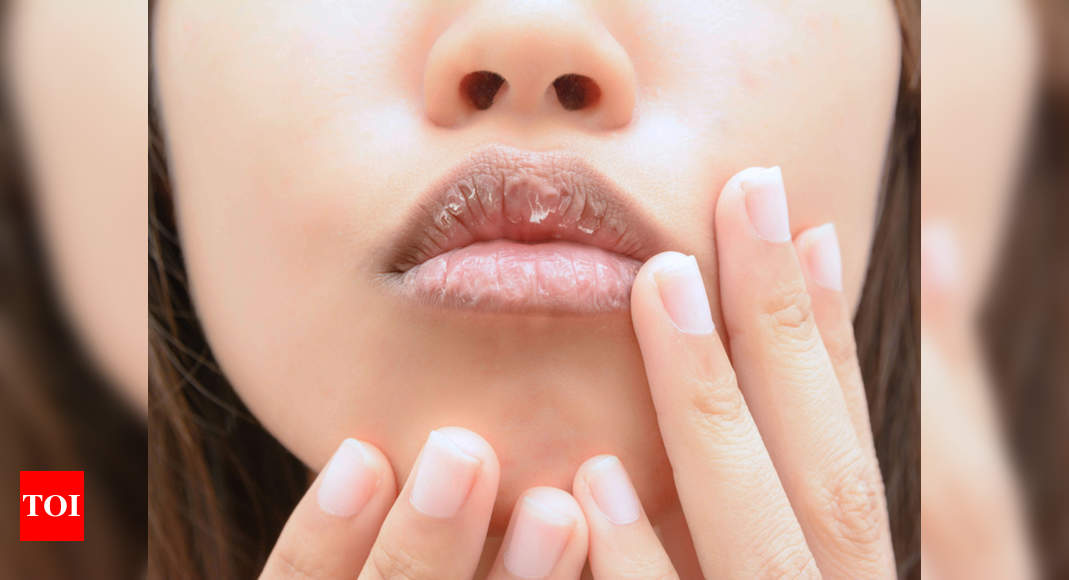 Home remedies for swollen lips