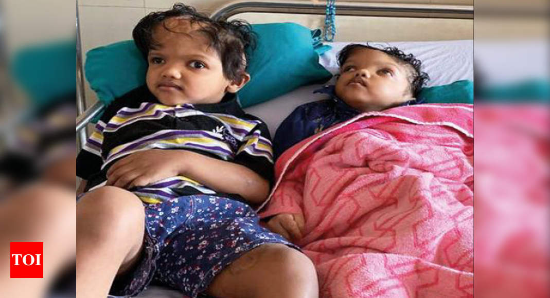 Once conjoined, twins ready for separate lives Delhi News Times of