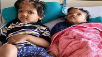 Delhi: Conjoined twins who came from Odisha, ready to lead separate lives