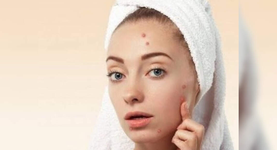 How To Get Rid Of Pimples Quickly