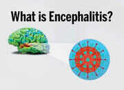 Encephalitis: All you want to know