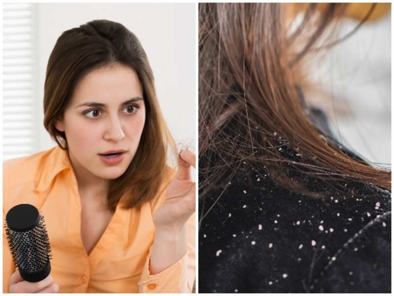 How to treat dandruff - Times of India