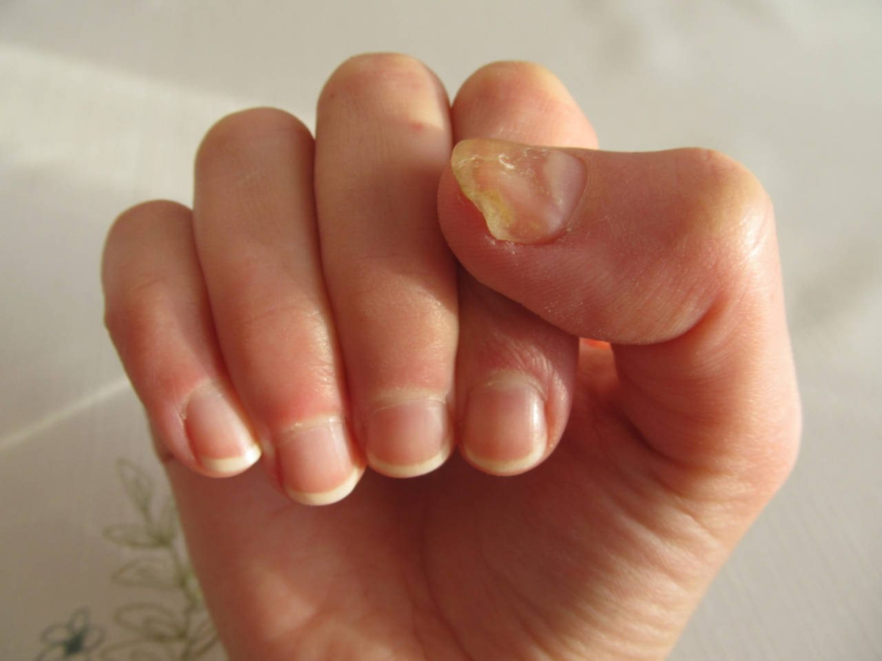 How To Whiten Polish-Stained Nails