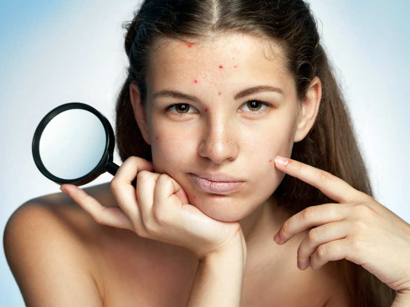 Acne Home Remedies: 5 Home Remedies to Treat Acne Naturally | How to Treat  Acne at Home